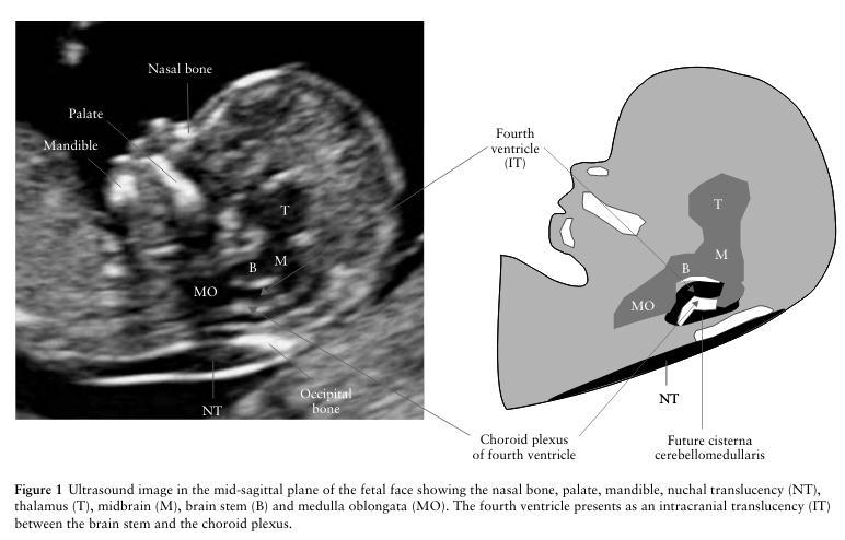 Espina bífida abierta Diagnóstico 11-13+6 sem Translucencia intracraneal (IV ventrículo) en feto normal Chaoui R et al.