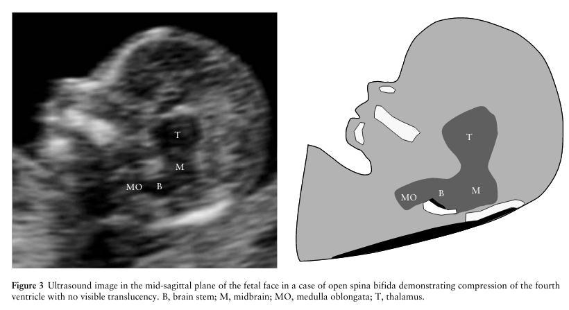 Espina bífida abierta Diagnóstico 11-13+6 sem Translucencia intracraneal ausente en fetos con espina bífida abierta. Chaoui R et al.