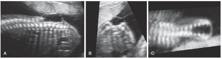 Copel J, D alton M, Gratacós E. Obstetric Imaging. 2012 Visual Encyclopedia for Ultrasound in Obstetrics & Gynecology, ISUOG. Espina bífida abierta Diagnóstico 22 sem 2.