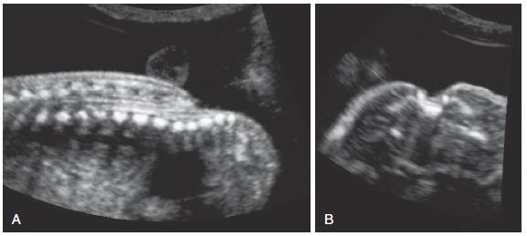 Copel J, D alton M, Gratacós E. Obstetric Imaging. 2012 Visual Encyclopedia for Ultrasound in Obstetrics & Gynecology, ISUOG.