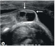 2012 Oct;33(4):E3 Espina bífida cerrada Diagnóstico 22 sem b) Lipomielomeningocele