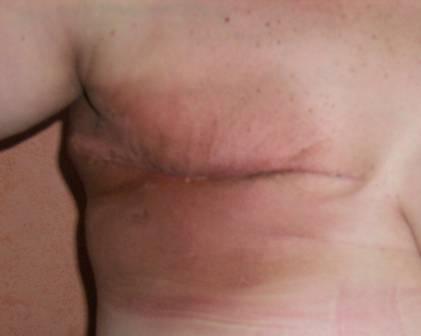 Exploración física Cicatriz de mastectomía amplia en mama derecha, cerrada