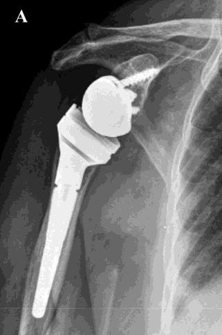 fracture in an elderly 77-year-old woman.