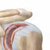 Un hombro deteriorado Espolón óseo Fracturas Cartílago desgastado La osteoartritis (artrosis) es el deterioro y desgaste