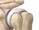 Muerte del hueso Articulación inflamada La artritis inflamatoria (reumatoide) es una enfermedad crónica de la