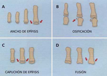 La secuencia de las cuatro fases de osificación progresiva a través del ensanchamiento epifisial en las falanges seleccionadas, la osificación del sesamoideo abductor del dedo pulgar, el capeamiento