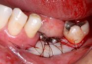 inmediata, implantes orales y los principales conceptos de manejo de tejidos blandos asociados a implantología y periodoncia.
