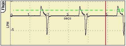 Nota: Los umbrales de alarma de presión alta y baja auto-ajustan la forma de onda de presión a 5 mbar en los modos normales de respiración y a 10 mbar en los modos HFO.