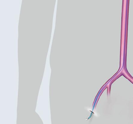 Reemplazo de la válvula aórtica transcatéter (RVAT) El RVAT puede ser una alternativa mejor para las personas que han recibido un diagnóstico de estenosis aórtica grave y su riesgo quirúrgico es