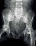 Las complicaciones óseas de la Enfermedad de Gaucher tipo 1 pueden incluir lo siguiente: (A) Infiltración de la médula ósea; (B) Deformidad en matraz de Erlenmeyer; (C) Osteonecrosis (D) Osteopenia;