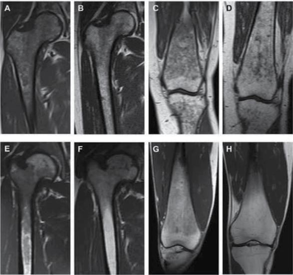 Tras 4 años de tratamiento con Cerdelga, se observaron mejorías en la infiltración de la médula ósea del fémur (evaluada a partir de RM, N = 18) en más de la mitad de los pacientes, y la CMO media de