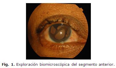 Causa en mayor o menor medida alteraciones de la córnea, trastornos pigmentarios de la superficie del iris, así como atrofia del mismo con diferente grado de severidad, provocando la formación de