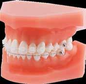 Modelo de ortodoncia para demostraciones discovery pearl Roth 22 Lleva montados: brackets cerámicos discovery pearl, maxilar/mandíbula 5-5
