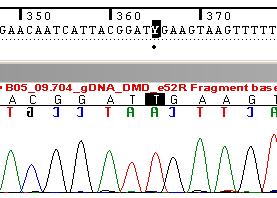 Mutaciones puntuales ESTUDIO GENÉTICO DEL GEN DMD Paciente DMD Cambio de una base que genera la formación de un codón de terminación prematuro.