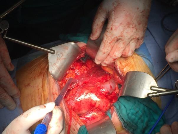 Arteriotomía longitudinal del saco y extracción de pus y trombo infectado. Se retira coils.