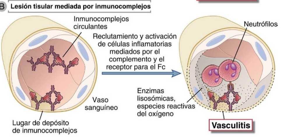 Generalidades de las Reacciones de hipersensibilidad tipo III Causada por el depósito de: Complejos inmunitarios, en tejidos y sitios