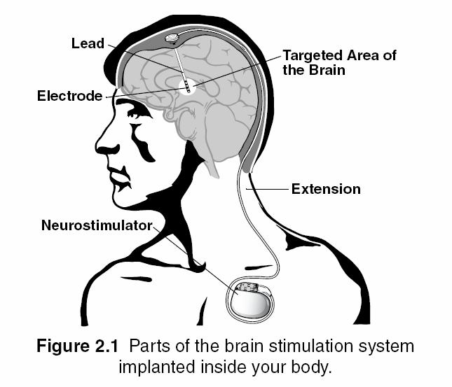 Deep Brain Stimulator - DBS Aplicaciones: