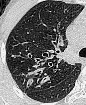 Bronconeumonía) Fibrosis quística Asma