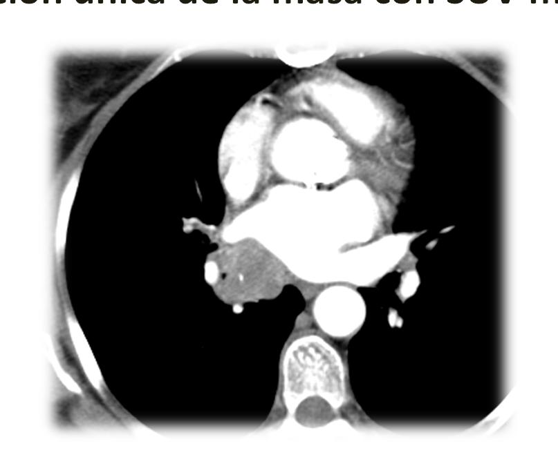 Tumores T4: infiltración auricular 69 años ECOG 1. No fumadora AP: prótesis valvular aórtica en 2010 Ca.