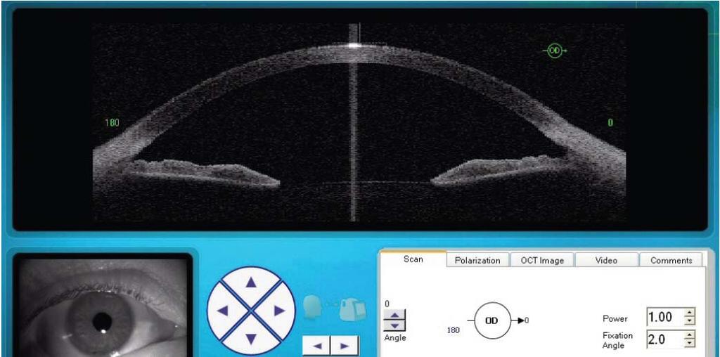 MATERIAL Y MÉTODOS de se desee comparar la tomografía de la cámara anterior con una tomografía de córnea y espera que las tomografías estén centradas en la misma área de la córnea.