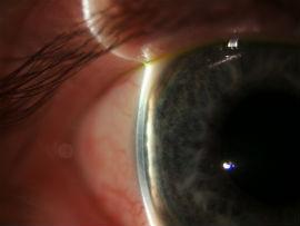 INTRODUCCIÓN realizara una sección óptica y comparando el grosor corneal con la distancia desde el endotelio hasta el iris.