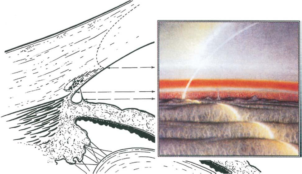 INTRODUCCIÓN La banda ciliar es la única parte del cuerpo ciliar visible por gonioscopía, cuyo color varía en función del color del iris siendo oscura en ojos con iris marrones y clara en ojos con