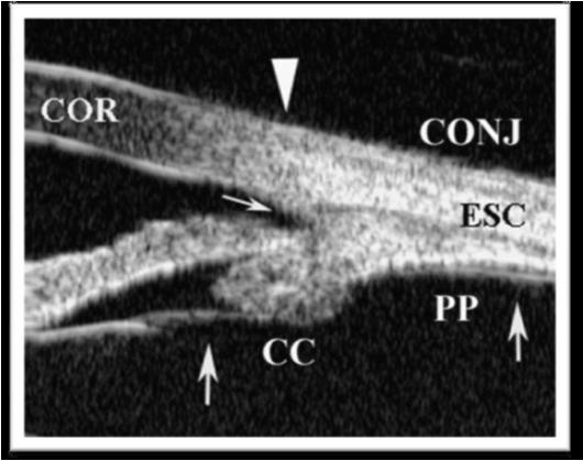 INTRODUCCIÓN La BMU permite obtener imágenes en tiempo real de la córnea, cámara anterior y estructuras de la cámara posterior como el cuerpo ciliar, la zónula, el cristalino y la coroide anterior.