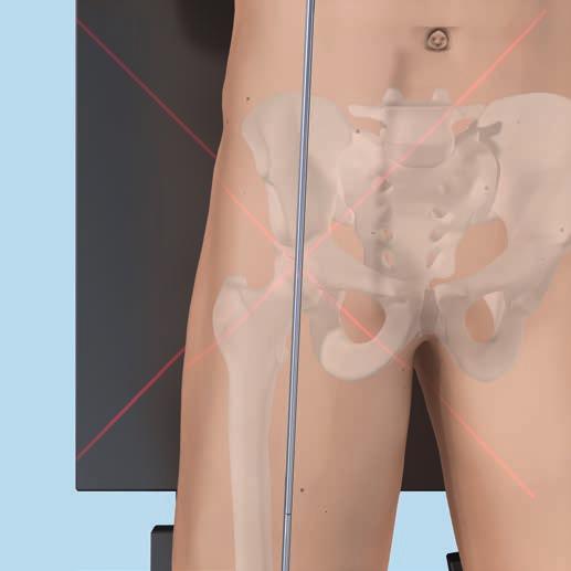 Técnica quirúrgica Uso intraoperatorio Tras haber practicado una osteotomía o haber reducido una fractura, use la barra de alineación para confirmar que el eje mecánico de la extremidad esté