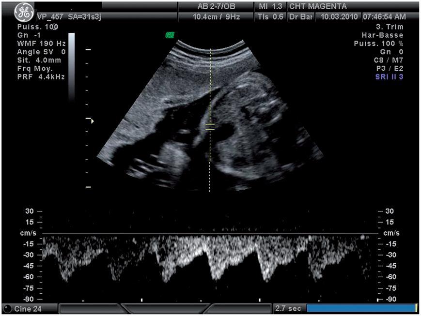 Notching of the umbilical artery waveform associated with cord