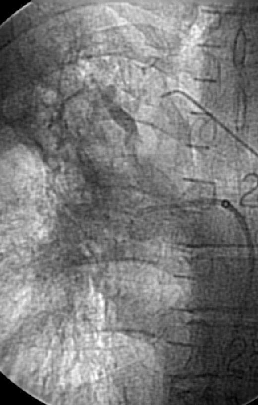 tardía, se ve una rama segmentaria de la arteria pulmonar opacificándose en forma retrógrada por mayor presión sistémica que