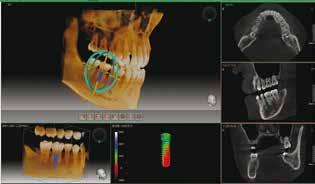 Simulación de Implantes - Inserte sistemas de implantes en tan solo 2 clicks.