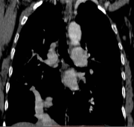 muestra una vena pulmonar anómala dilatada en el