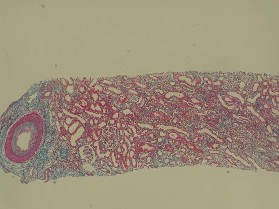 A.- Muestra adecuada >12 glomerulos (Banff) 2 arterias No < de 14 glomerulos permiten moderada reproducibilidad No reproducibilidad en Fibrosis Intersticial y/o atrofia tub.