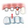 soluciones completas para cada indicación pérdida de un diente Estándar Esthetic Abutment Procera Crown NobelRondo pérdida de varios dientes Estándar Procera Implant Bridge (nivel de implante)