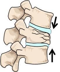 Fracturas vertebrales La más frecuente, afectando al 30-50% de la población mayor de 50 años 1 La mayoría de las fracturas vertebrales son consecuencia de osteoporosis 1 1.