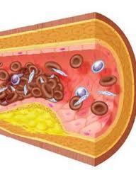 Dislipidemia: El aumento del colesterol y los triglicéridos está en relación con la dieta, la actividad física, la genética y el peso.