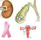 Tumores: La obesidad se ha relacionado con la presencia de algunos tipos de cáncer.