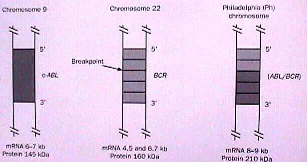 Ph cromosome, CML t(9;22)(q34;q11) Abl codifica tirosina quinasa que cuando se fusiona con Bcr