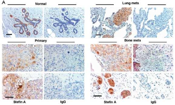 PEFF sections of reduction mammoplasty tissue, primary breast tumours and metastases in lung and bone were stained with mouse anti-human Stefin A or 1B5