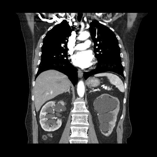 TAC abdomino-pélvico con contraste Ureterohidronefrosis renal bilateral grado III-IV/IV con adelgazamiento