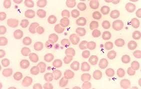 En los extendidos de sangre preparados inadecuadamente, las plaquetas pueden formar grandes agregados en algunas áreas y aparecen disminuidas o ausentes en otras.