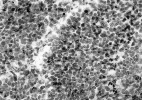 Oncología, 2007; 30 (1):32-36 Figura 3. Imagen microscópica (400X) con tinción inmunohistoquímica para Factor de Transcripción Tiroideo (TTf-1), procedente de la biopsia de la lesion fronto-orbitaria.