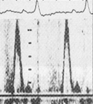 Los valores E/A > 2, TDE < 150 ms, TRIV < 60 ms Figura 5 Doppler Tisular El doppler tisular es una técnica de doppler pulsado que mide las velocidades de movimiento del tejido (miocardio).