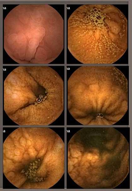 M. Digestiva: Gastroscopia Acantosis glicogénica de enf. Cowden en esófago.
