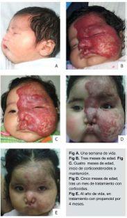 Pediatría Los hemangiomas faciales son el hallazgo cardinal de este síndrome.