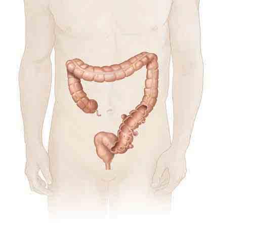 Diverticulosis Cuando se forman bolsas en la pared del colon, usted tiene diverticulosis. Es muy raro que esta afección cause síntomas.