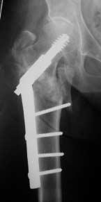 Año 71 Número 3 Septiembre de 2006 Salvataje de fallas en fracturas laterales de cadera 233 Arthroplasty is technically more difficult, and we choose this procedure in patients with poor bone quality