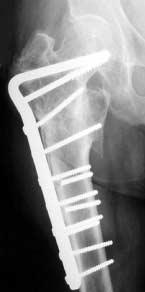 Las fracturas laterales de cadera pueden ser tratadas satisfactoriamente con reducción abierta y fijación interna. Sin embargo, en un pequeño porcentaje de pacientes el tratamiento puede fallar.