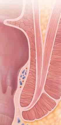 Un exceso de presión en el canal anal puede inflamar estos tejidos y provocar los síntomas.