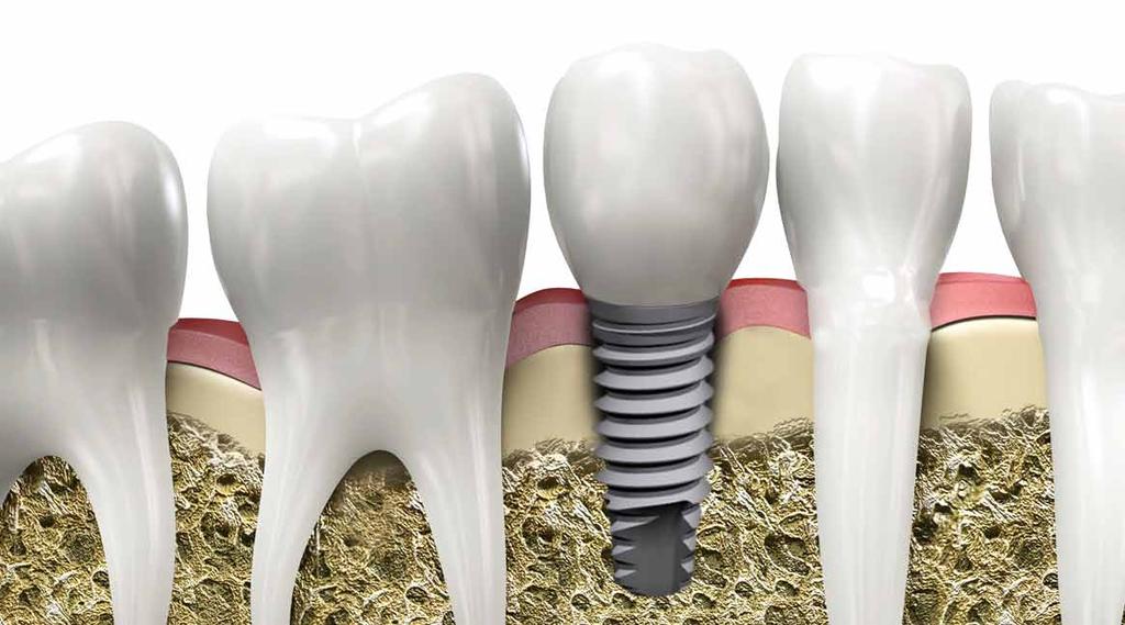 Qué beneficios tiene la colocación de un implante dental? 3.